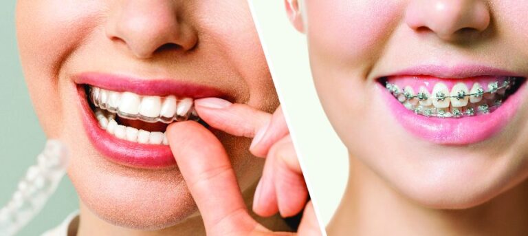A woman fitting a clear aligner over her teeth, next to a smiling woman wearing metal braces