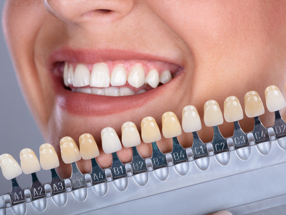 A patient's smile held next to a dental shade guide, used to match the colour of veneers to the natural teeth