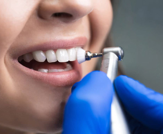 Close-up of a dentist polishing a patient's teeth with a small rotating brush