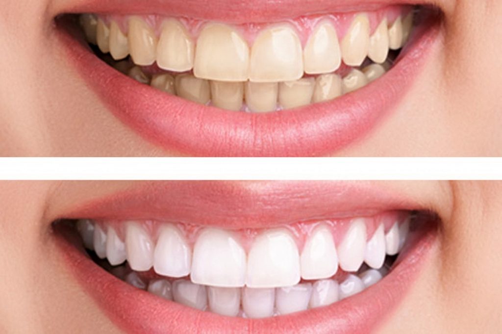 Two close-up smiles compared: teeth with yellow staining above and lighter teeth below. Stock photo, not a patient of Gangtok Dental Clinic