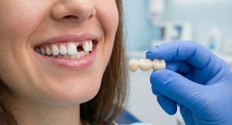A patient with a gap where a tooth is missing, beside a dentist's gloved hand holding a three-unit dental bridge