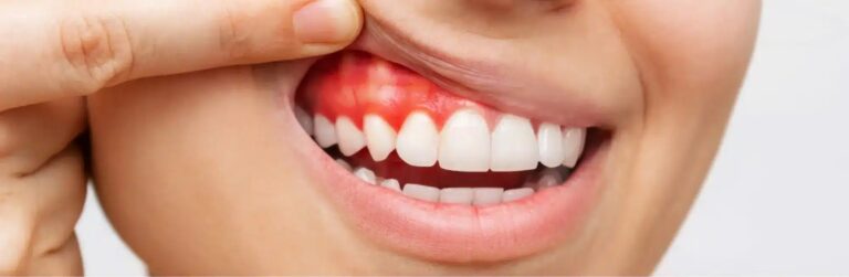 A close-up of a smile with a red, swollen gum above the upper front teeth, a sign of gum inflammation